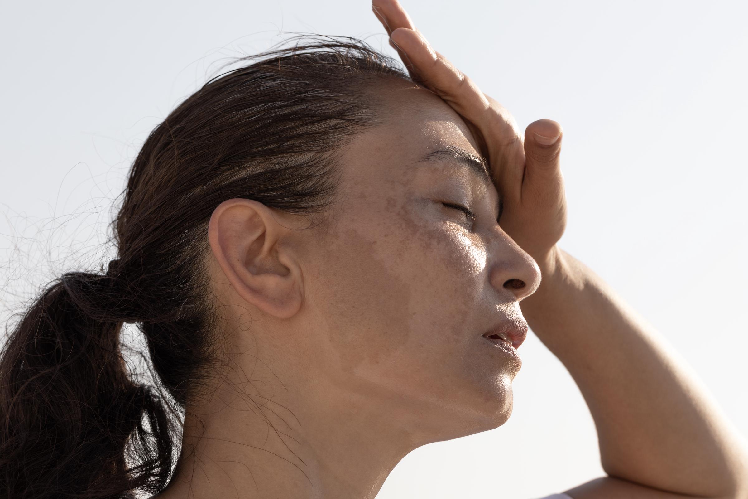 A woman with dark patches on her skin | Source: Getty Images
