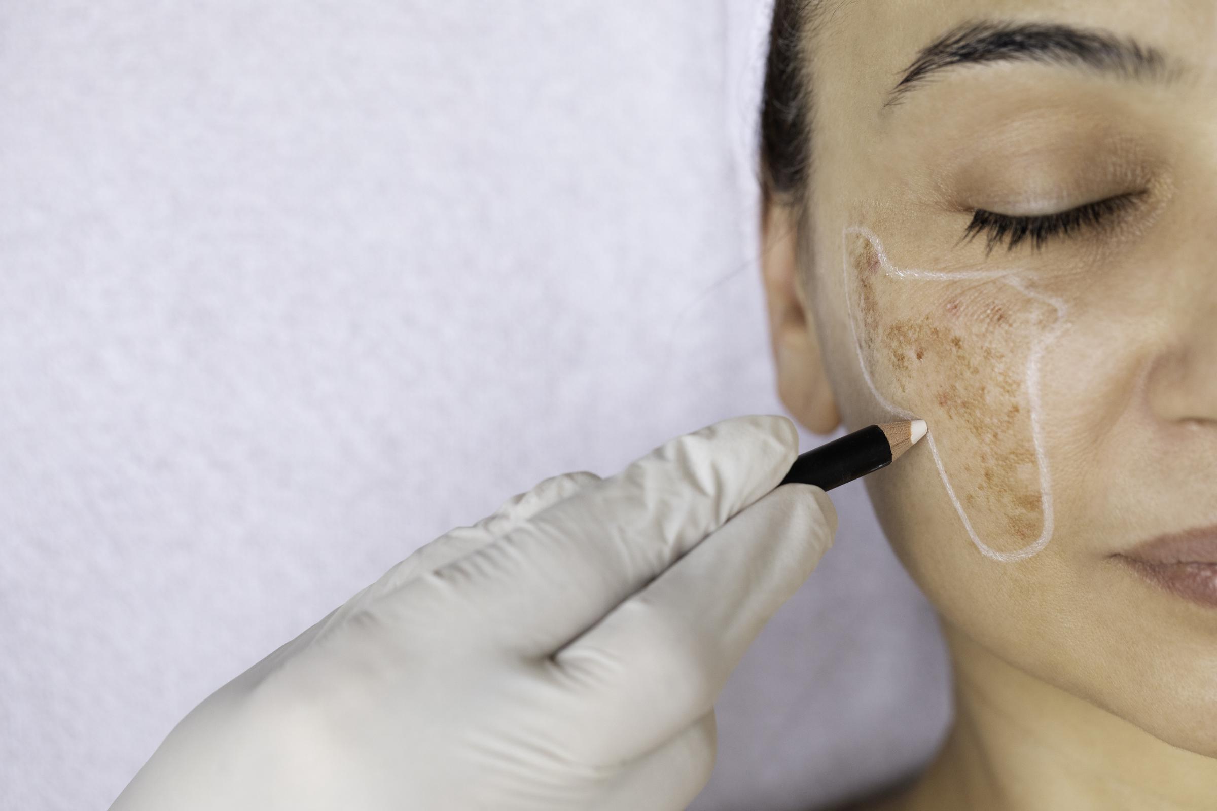 A medical professional outlining melasma on a woman's face | Source: Getty Images