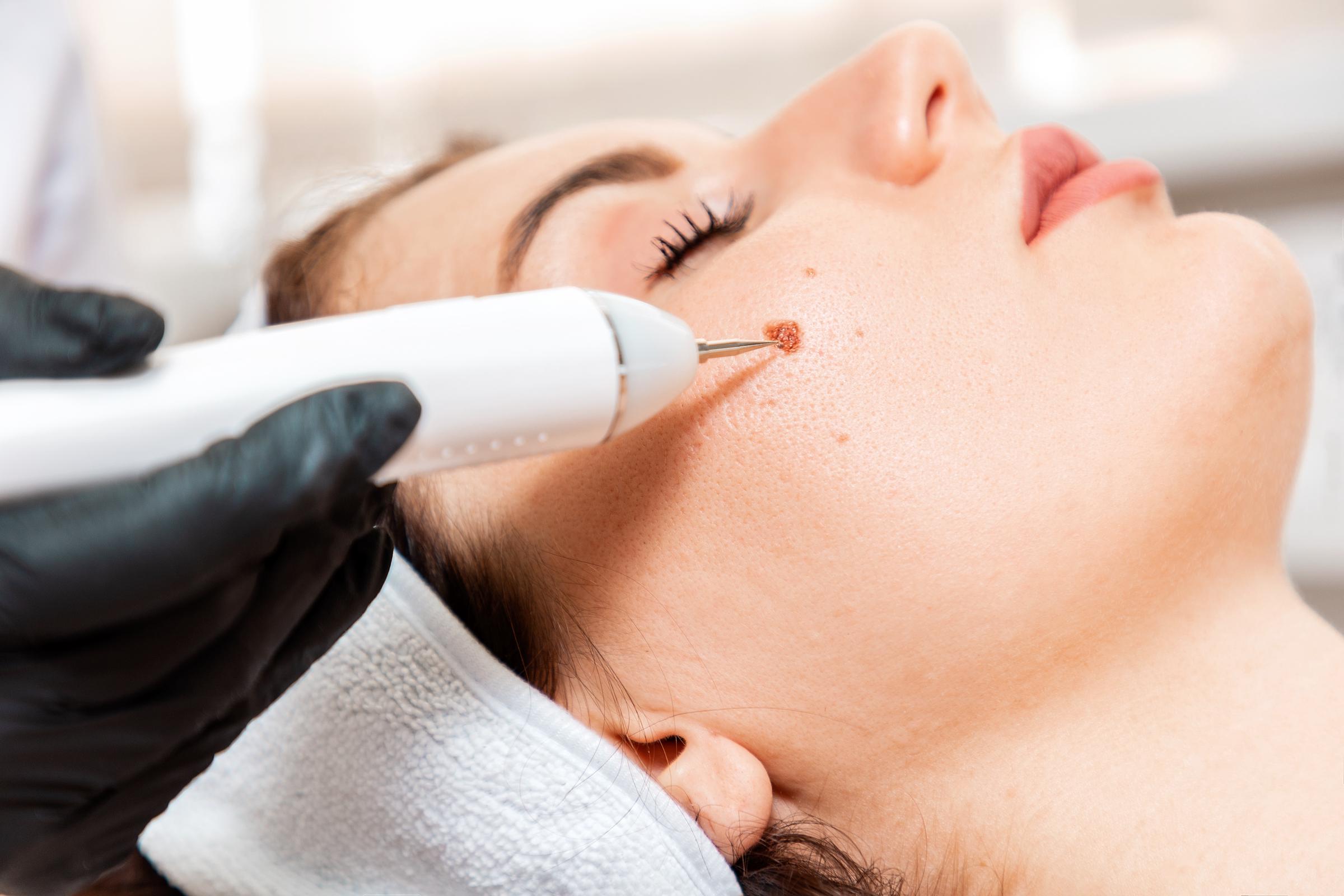 A woman undergoing laser therapy on her face | Source: Getty Images